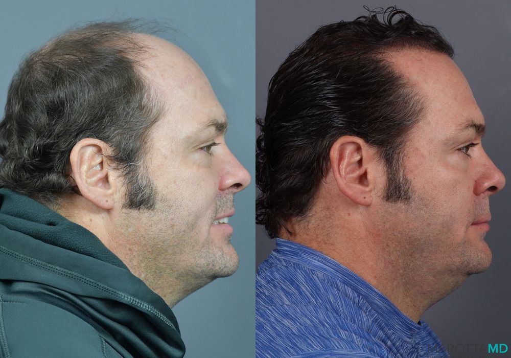 Hair Transplantation - Thumbnail 2