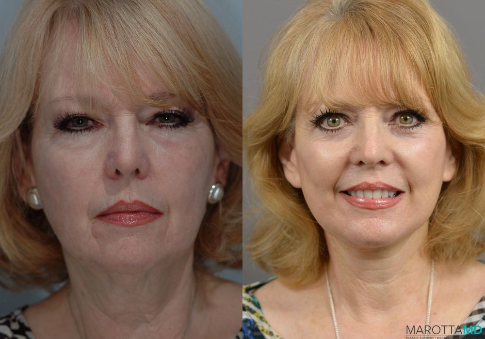 Facelift & Neck Lift - Case 996