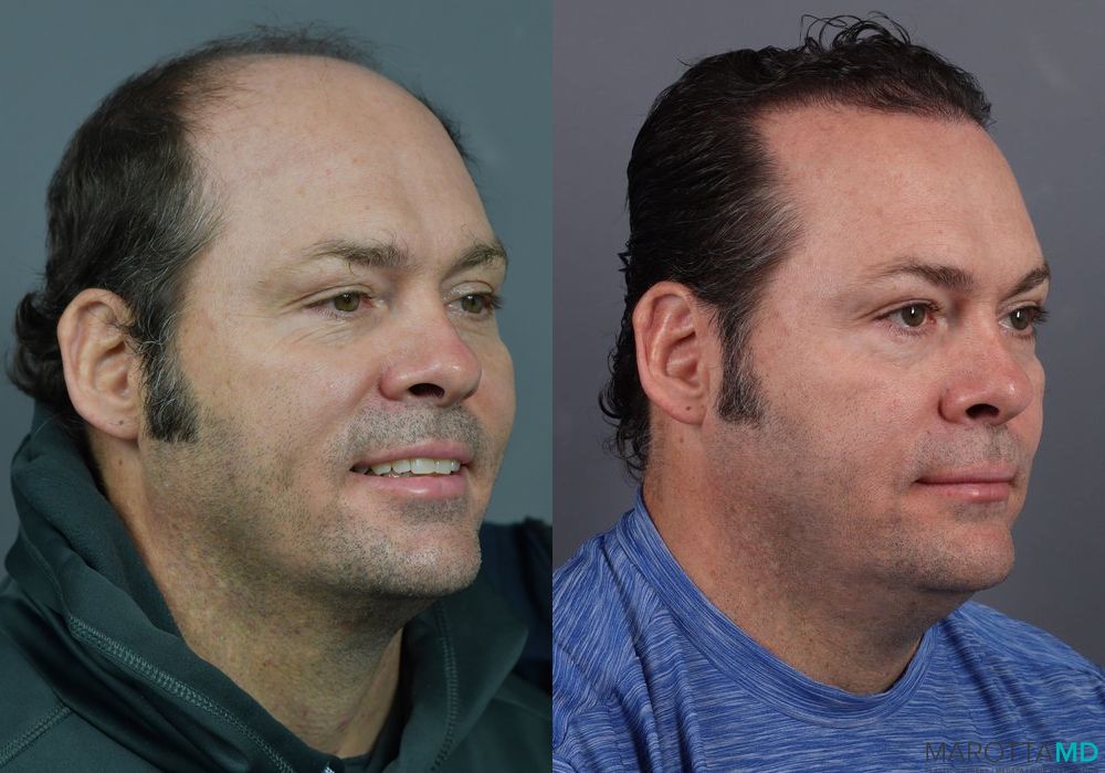 Hair Transplantation - Thumbnail 3