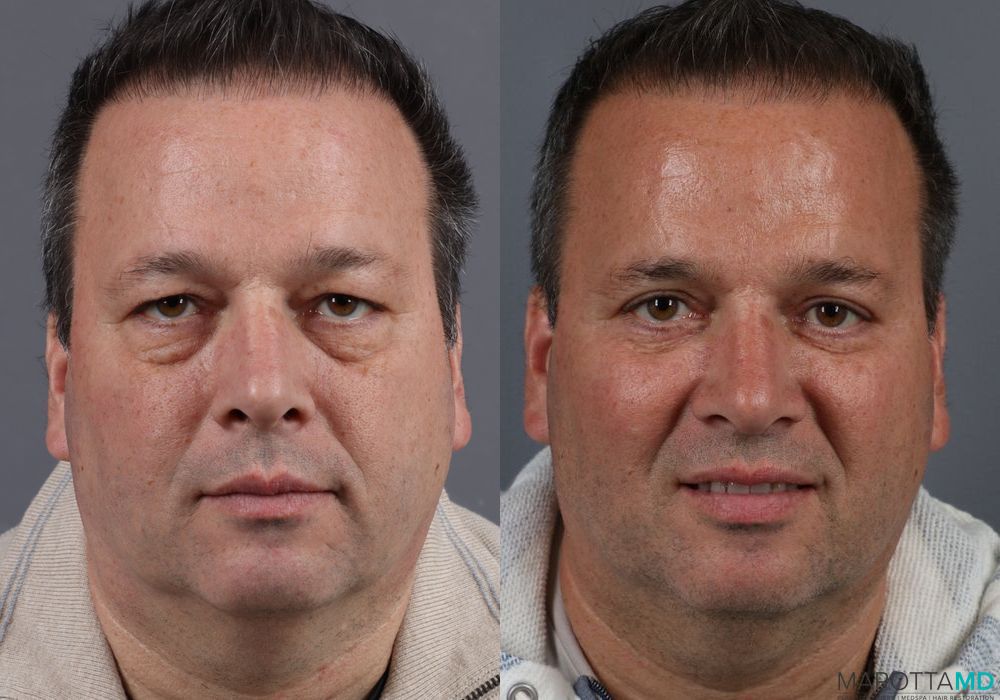 Blepharoplasty - Case 154