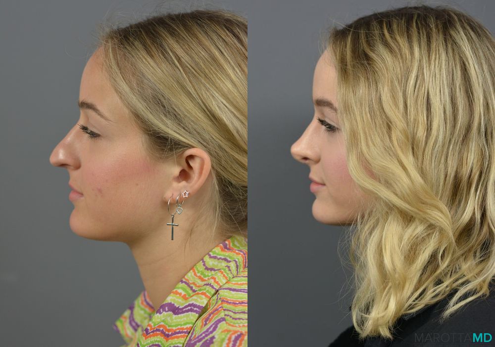 Rhinoplasty - Case 619