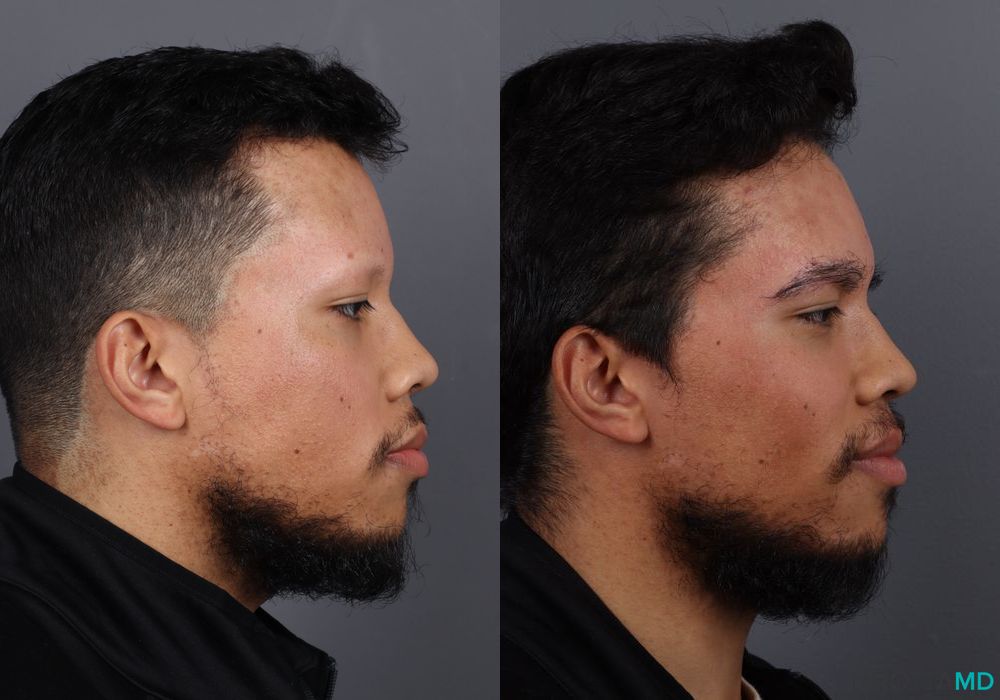 Hair Transplantation - Thumbnail 3