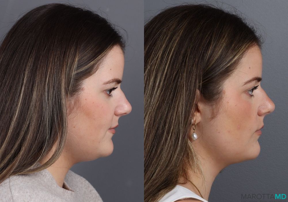 Before and after Liposuction of the Neck case 7011 - Angle 3