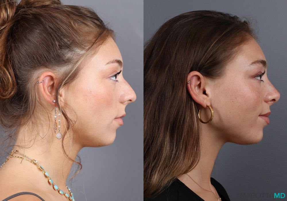 Before and after Rhinoplasty case 7264 - Angle 5
