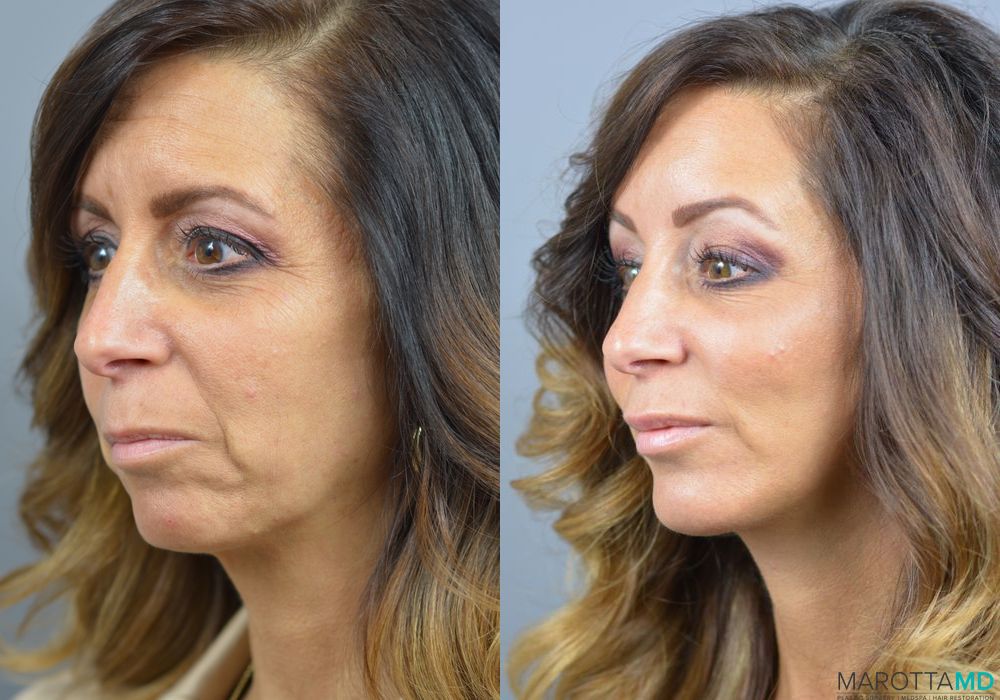 Mini Facelift - Thumbnail 2