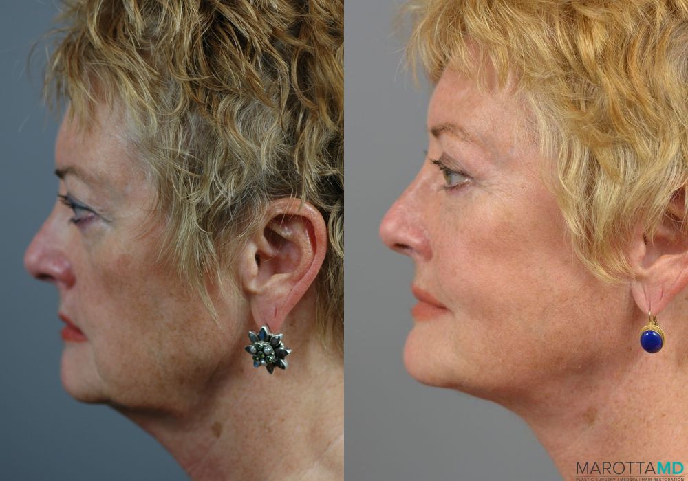 Before and after Fat Transfer - Face case 7227 - Angle 4