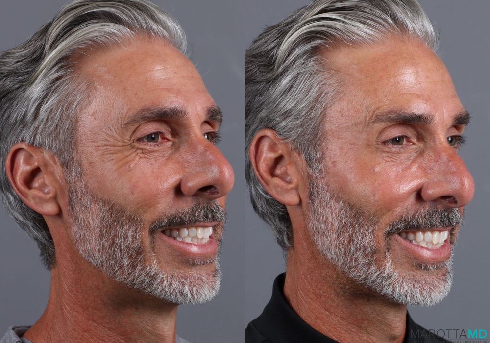 BOTOX® Cosmetic - Case 369