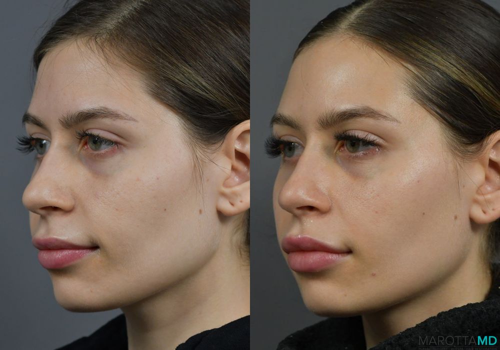 Before and after Botox - Lip Flip case 7289 - Angle 3