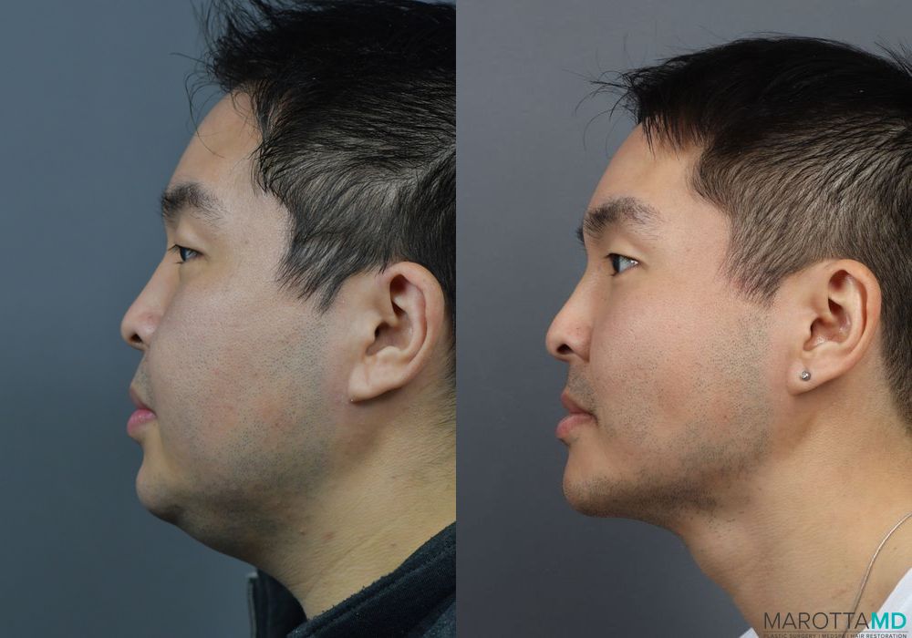 Liposuction of the Neck - Thumbnail 2