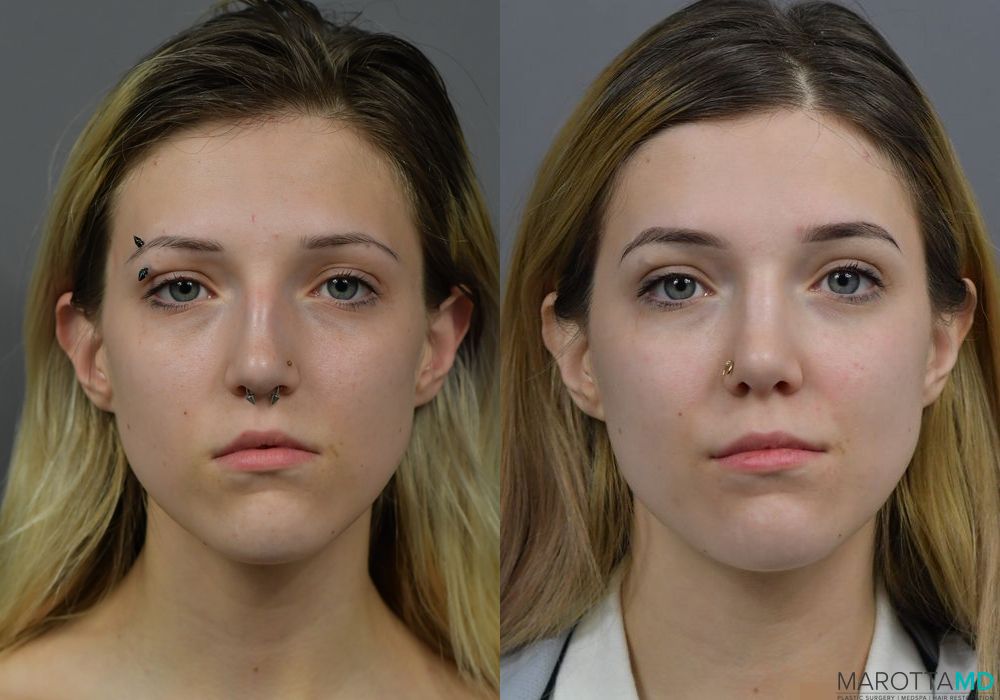 Before and after Rhinoplasty case 7257