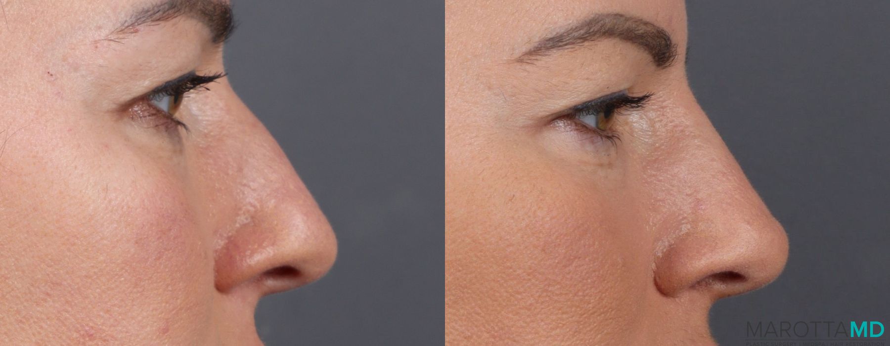 Non-Surgical Rhinoplasty - Thumbnail 4