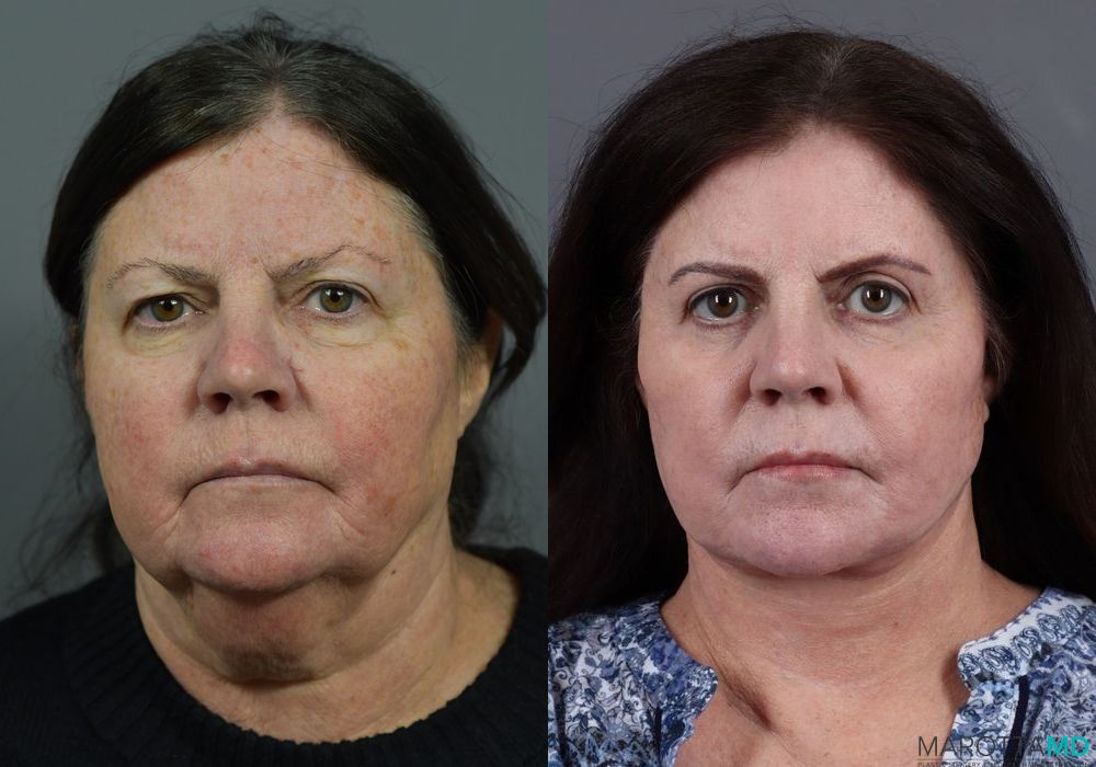 Laser Skin Resurfacing - Face - Case 214