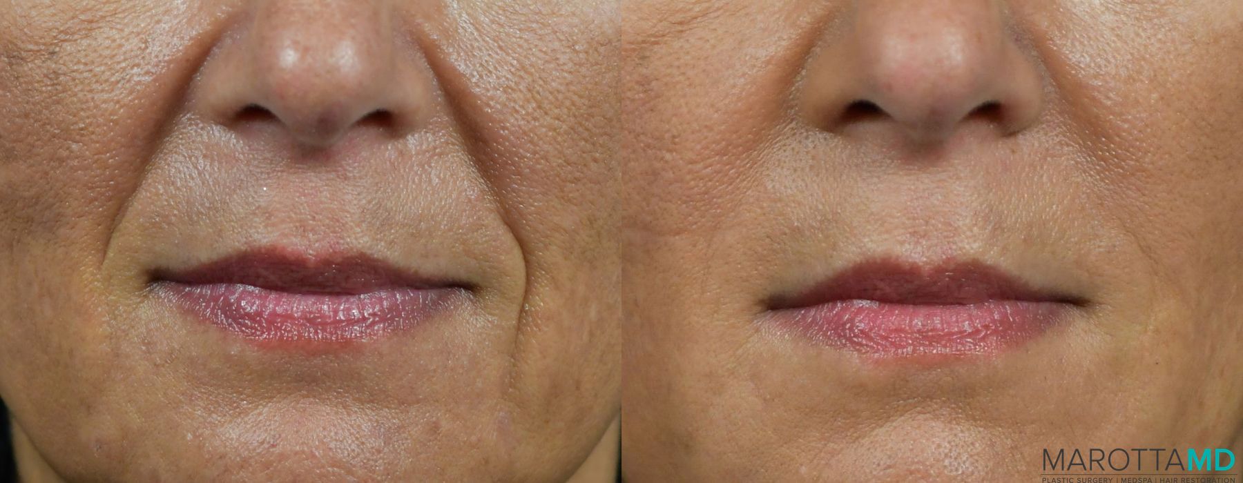 Before and after Juvederm / Fillers case 7260