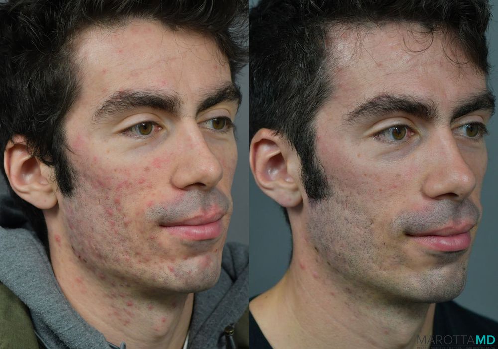 Microneedling - Thumbnail 2