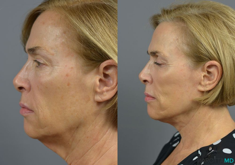 Facelift & Neck Lift - Thumbnail 3