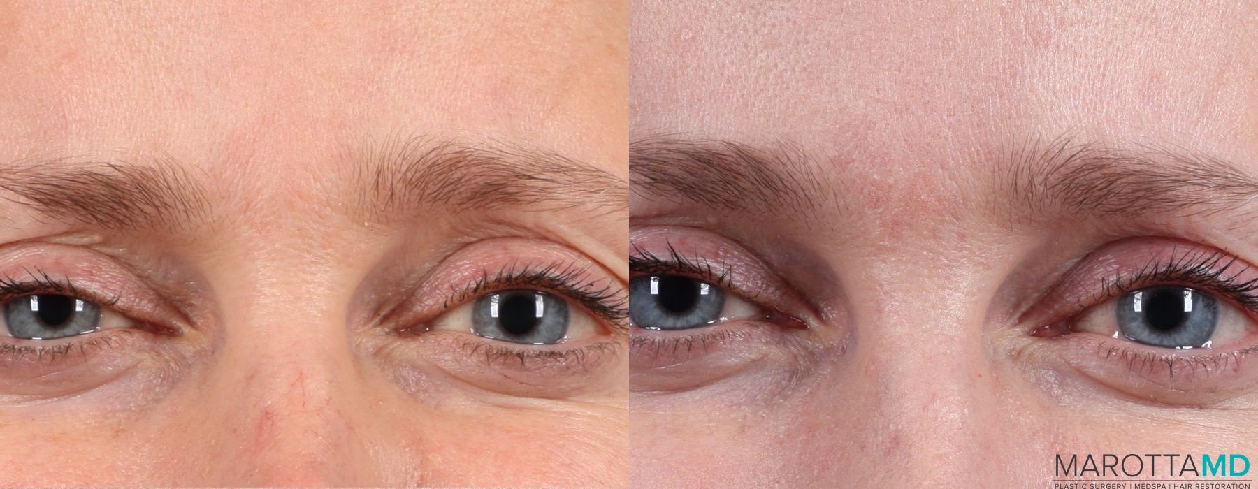 Botox - Crow's Feet - Case 303