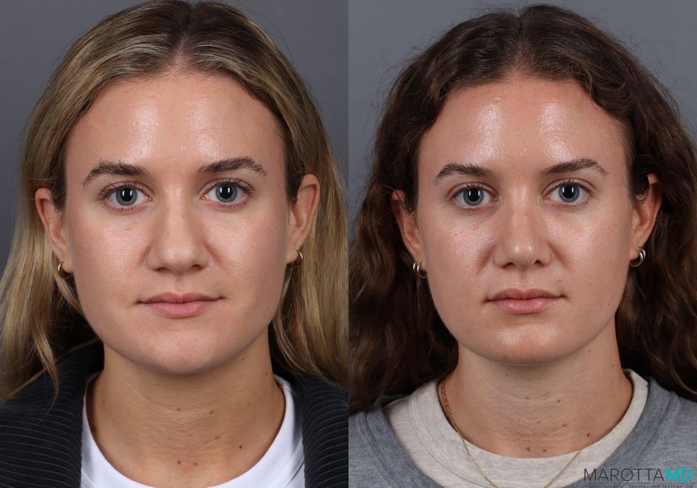 Rhinoplasty - Thumbnail 3