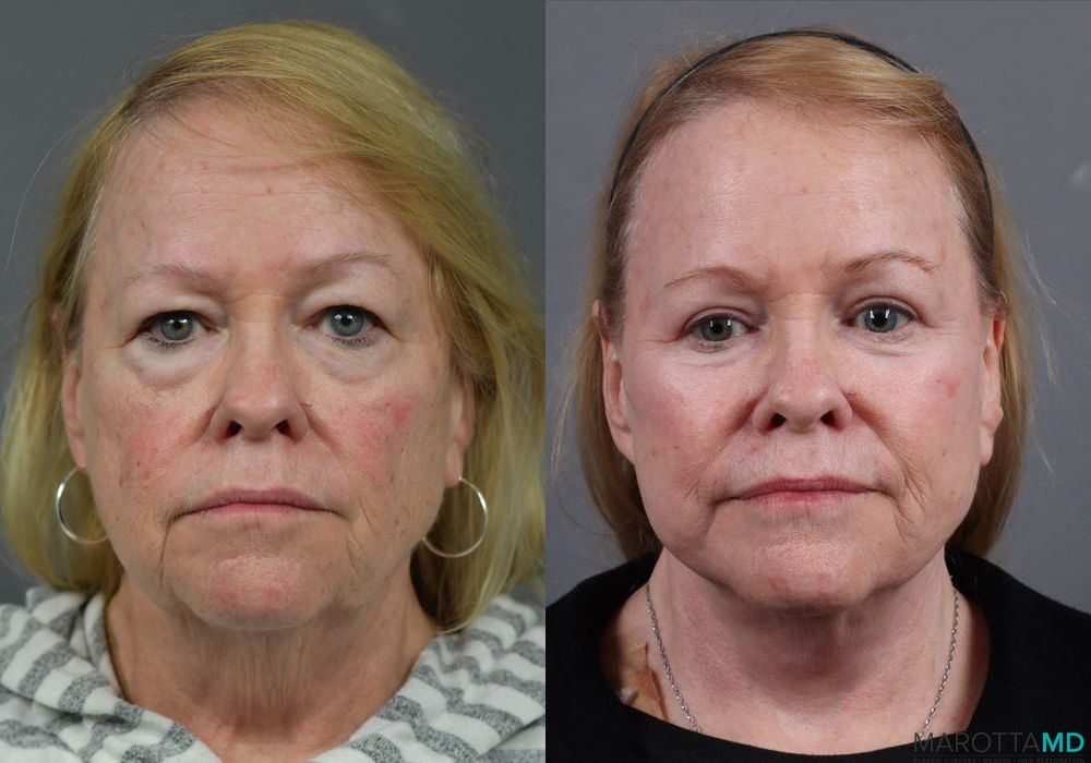 Blepharoplasty - Case 153