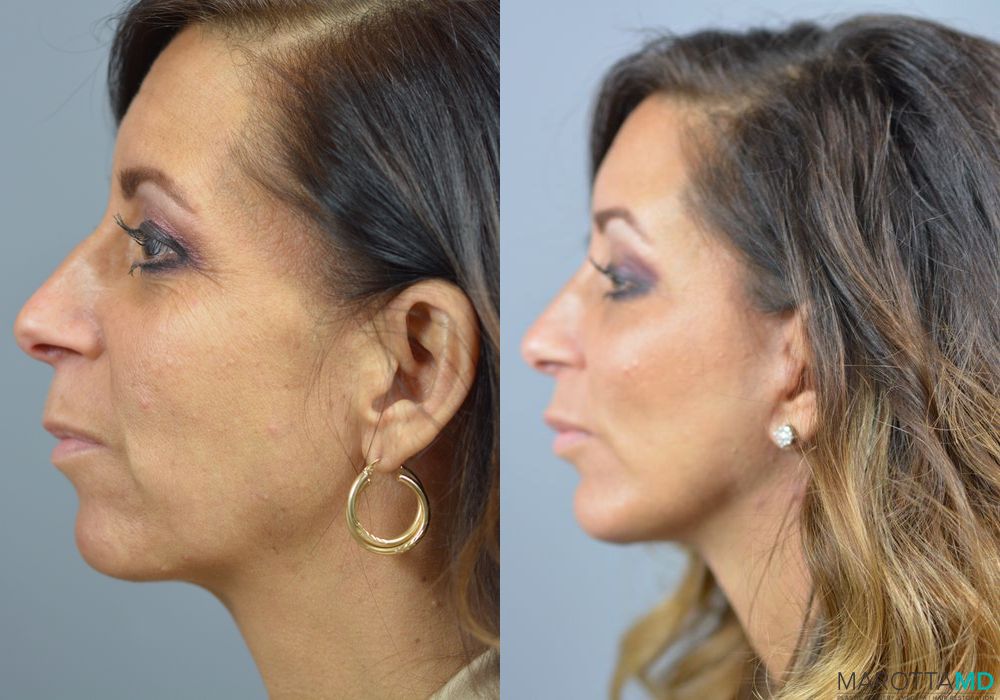 Chin Implant - Thumbnail 4