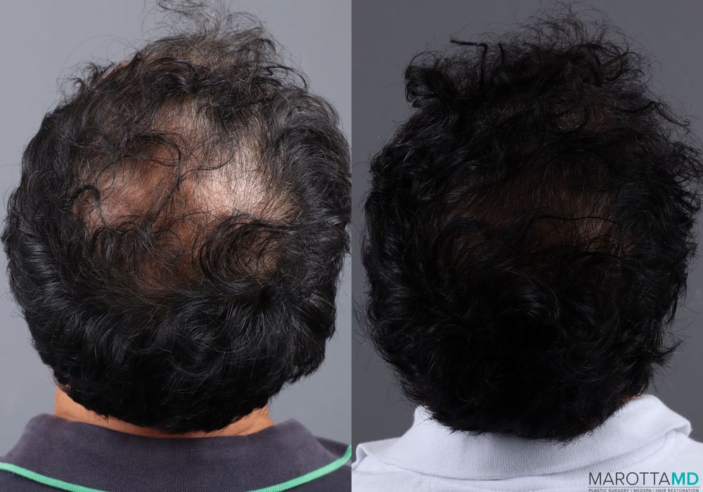 Hair Transplantation - Thumbnail 2