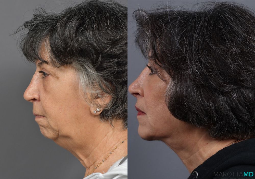 Before and after Chin Implant case 7027 - Angle 5