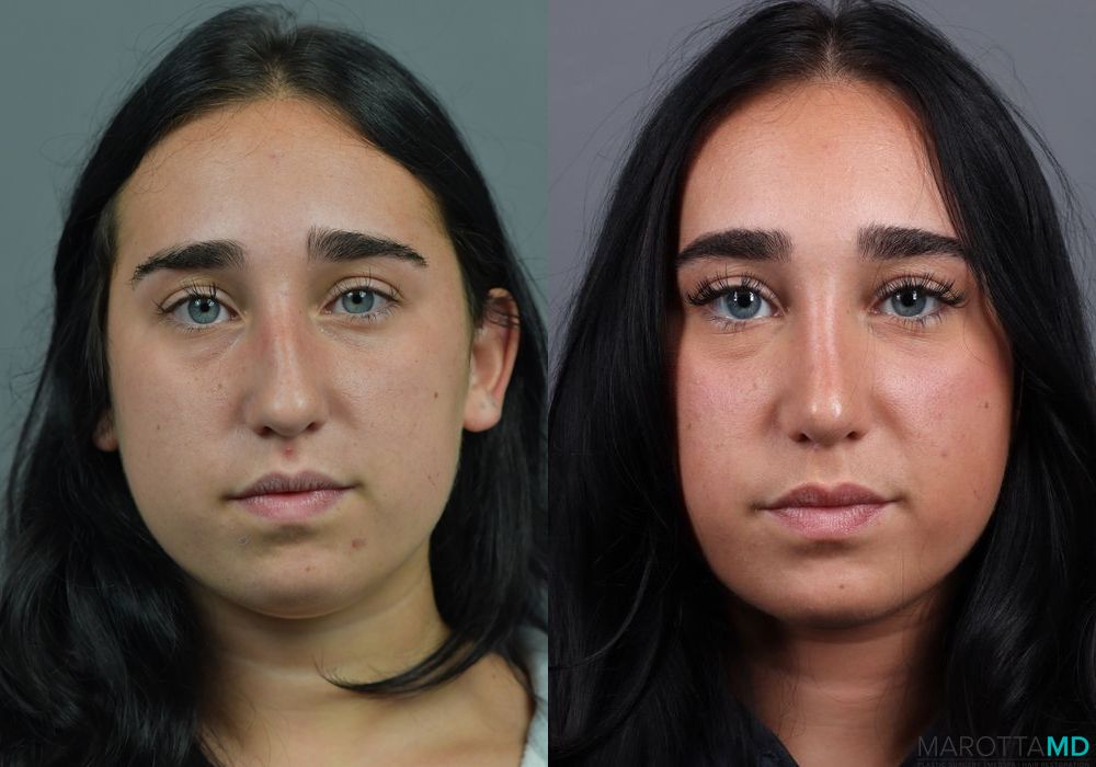 Before and after Rhinoplasty case 7286