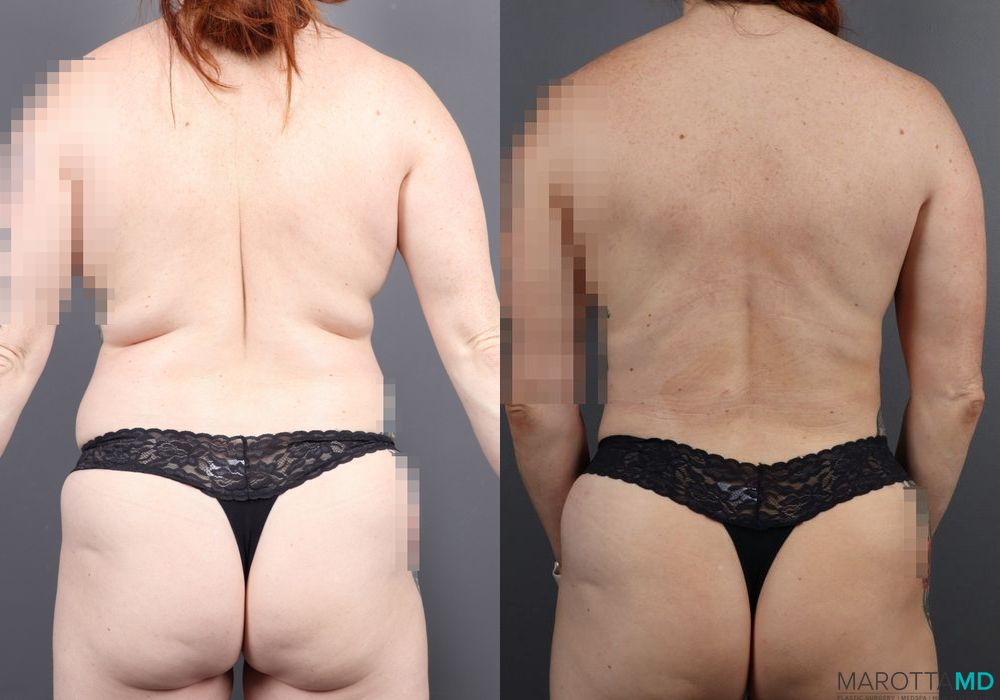 Before and after Renuvion case 7035 - Angle 2