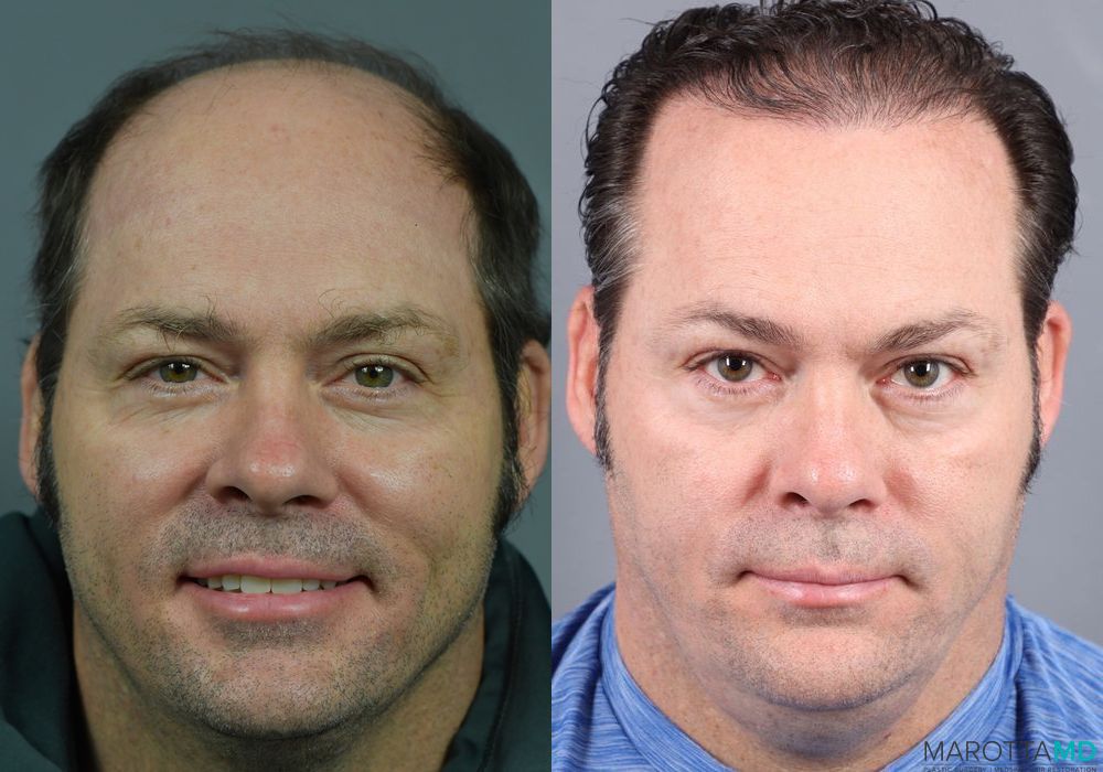 Hair Transplantation - Thumbnail 5