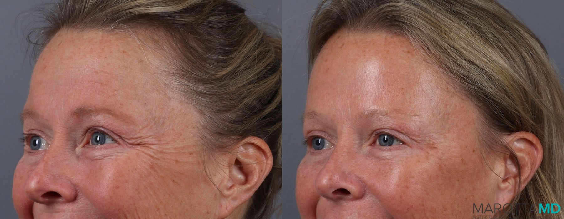 Before and after Botox - Forehead case 7128 - Angle 3