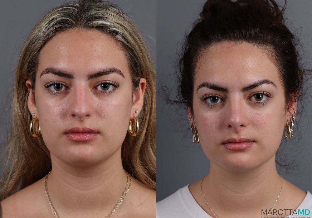 Before and after Rhinoplasty case 7250