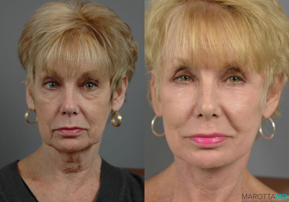 Facelift & Neck Lift - Case 997