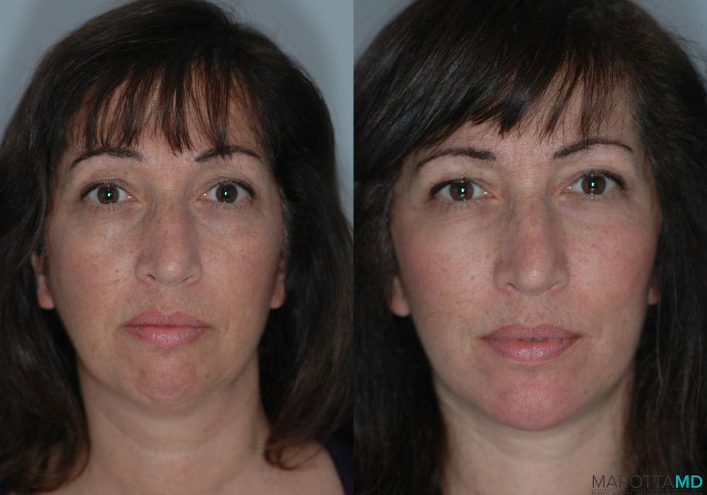 Facelift & Neck Lift - Thumbnail 3