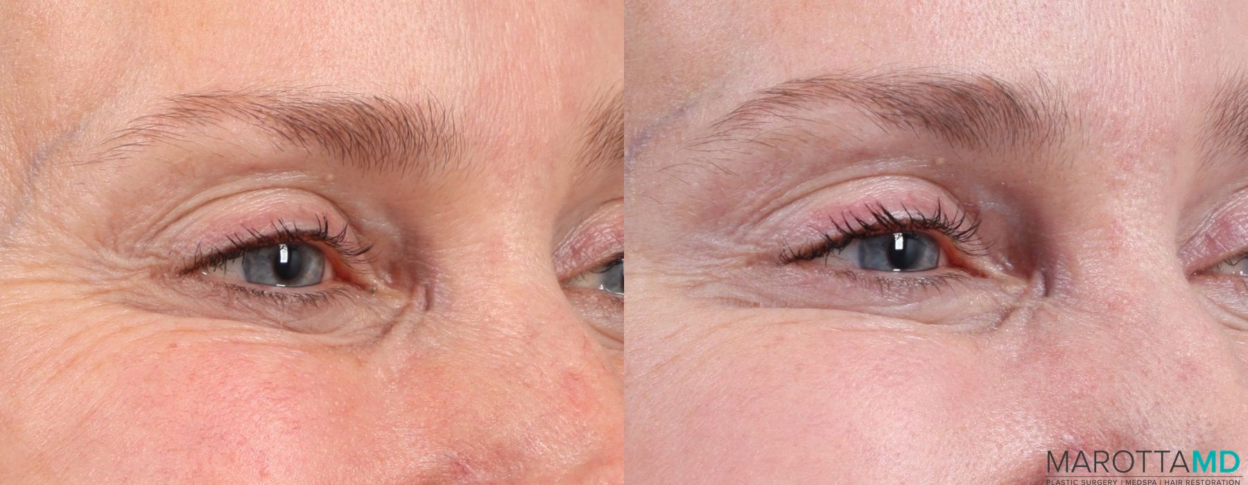 Botox - Crow's Feet - Thumbnail 2