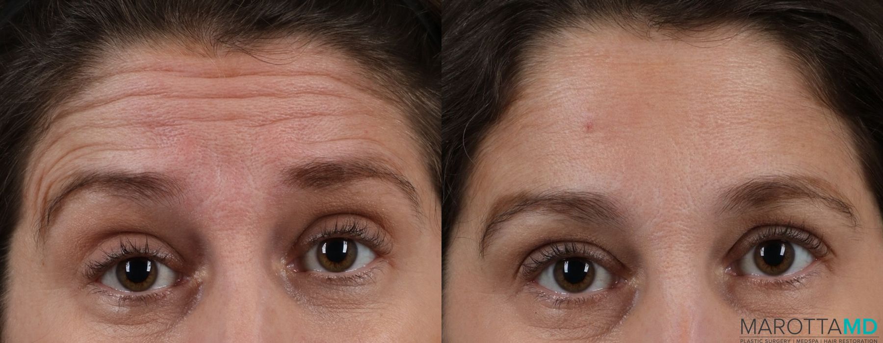 Before and after Botox - Crow's Feet case 7167 - Angle 2
