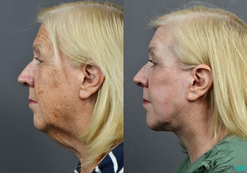 Facelift & Neck Lift - Thumbnail 3