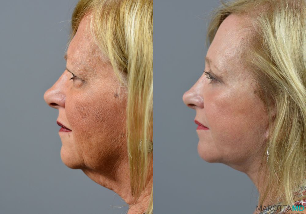 Facelift & Neck Lift - Thumbnail 3