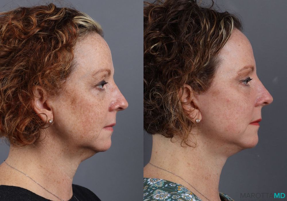 Mini Facelift - Thumbnail 5