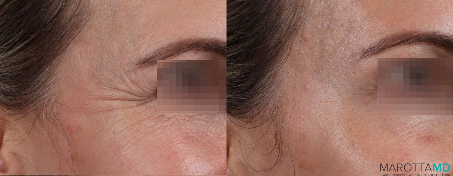 Before and after Botox - Crow's Feet case 7160 - Angle 3