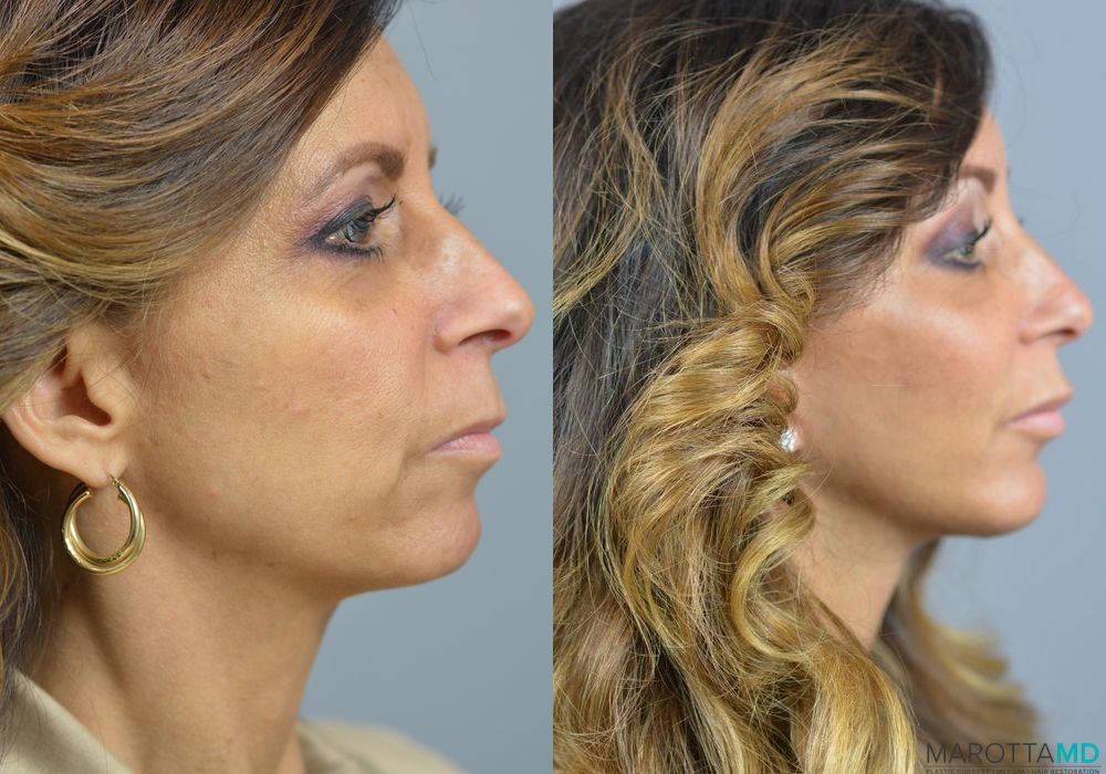 Chin Implant - Thumbnail 5