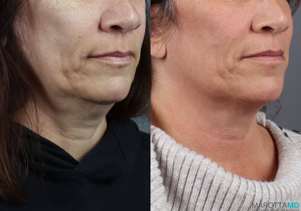 Before and after Genius Radio Frequency Microneedling case 7251 - Angle 2