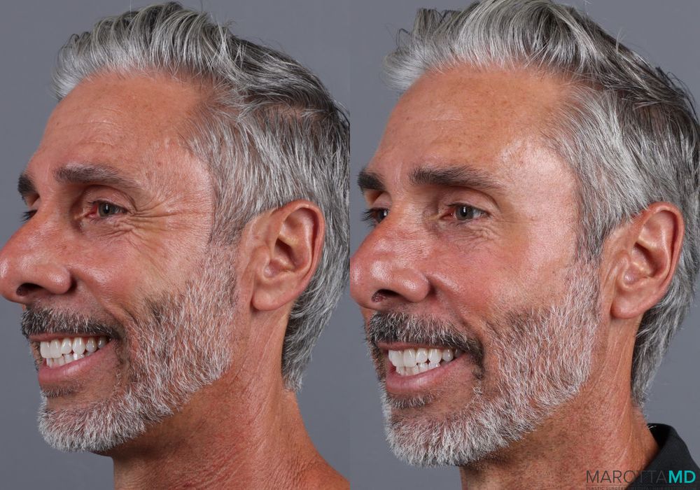 BOTOX® Cosmetic - Thumbnail 2