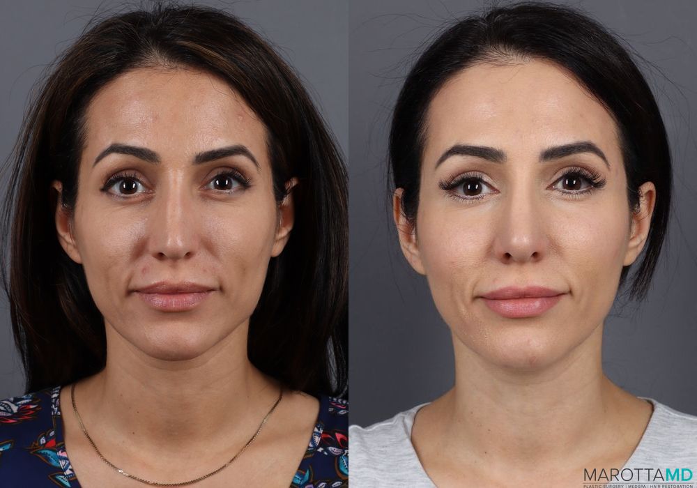 Filler - Lips - Case 400