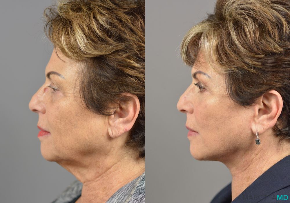 Before and after Facelift & Neck Lift case 7023 - Angle 5