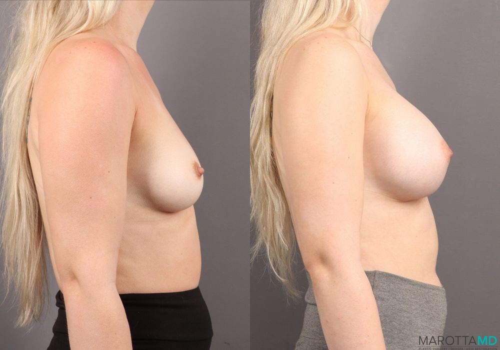 Breast Augmentation - Thumbnail 2