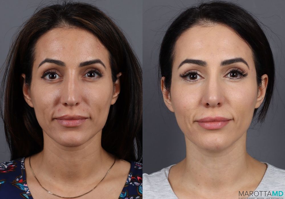 Rhinoplasty - Thumbnail 2