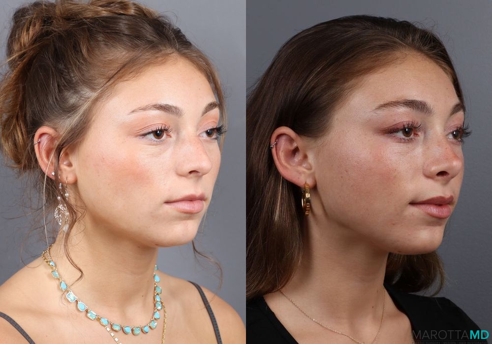 Before and after Rhinoplasty case 7264 - Angle 4