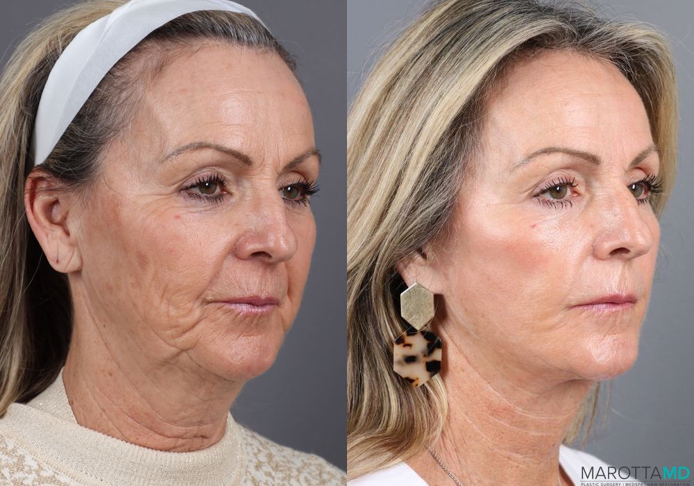 Laser Skin Resurfacing - Face - Case 1028