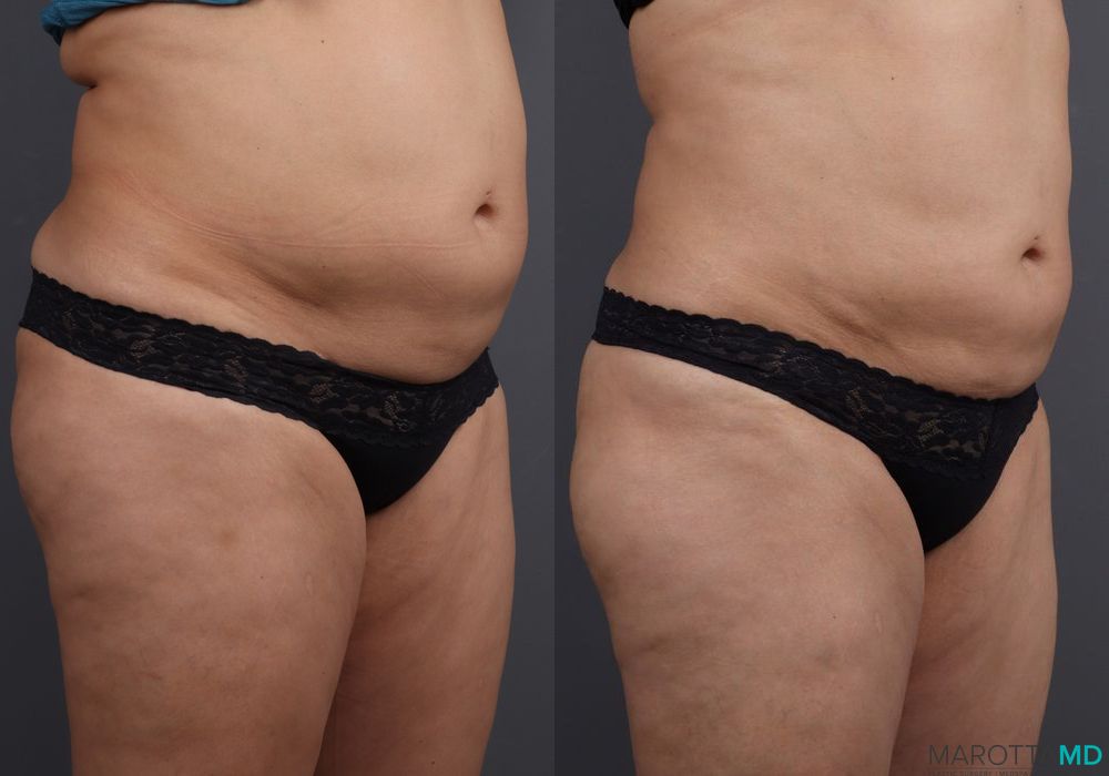 EMSCULPTĀ® - Thumbnail 2