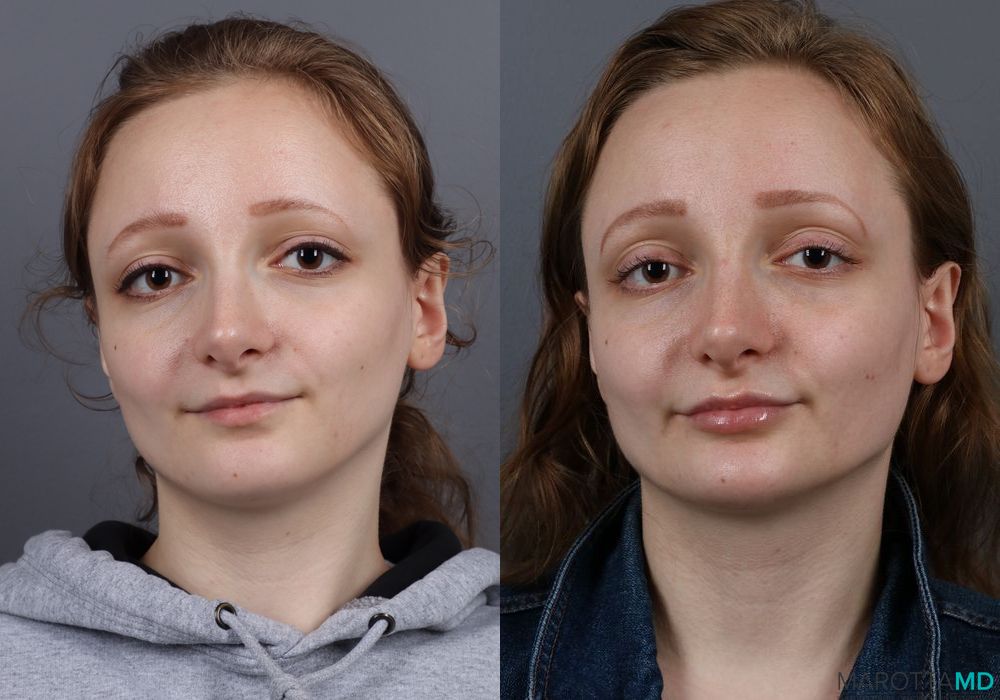 Before and after Fillers case 7141