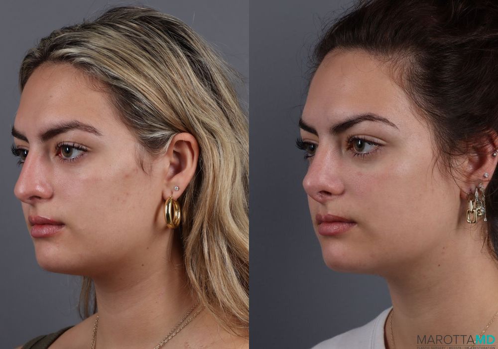 Before and after Rhinoplasty case 7250 - Angle 4